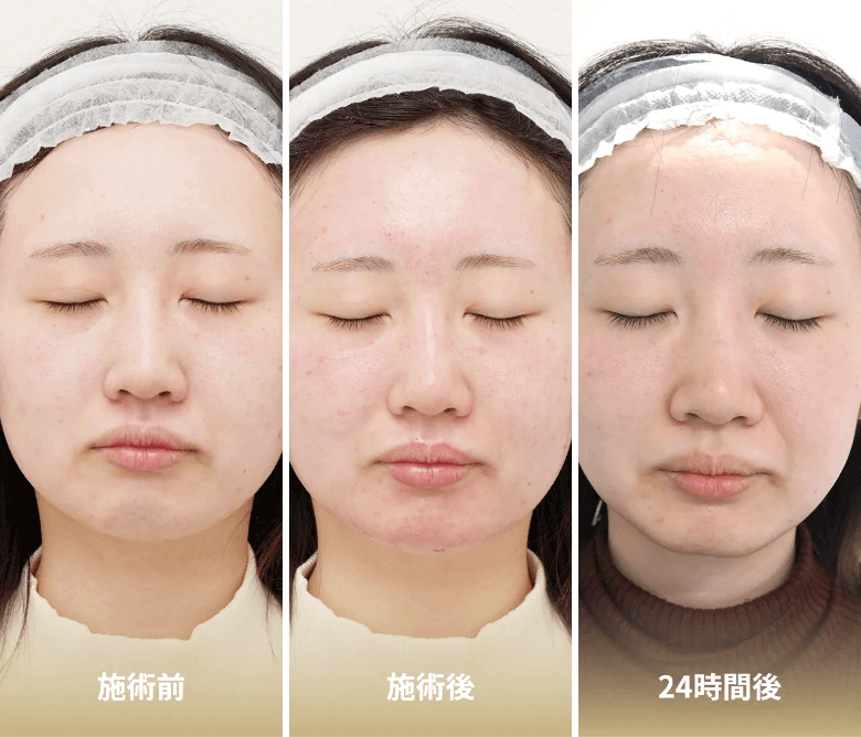 ダウンタイム経過写真